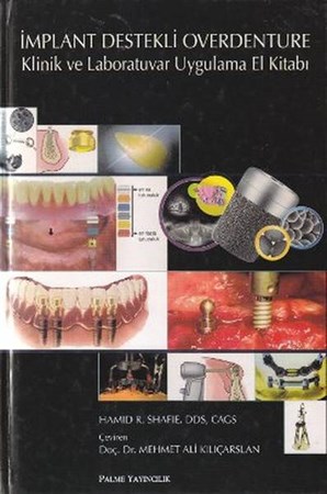 İmplant Destekli Overdenture Klinik Ve Laboratuvar Uygulama El Kitabı